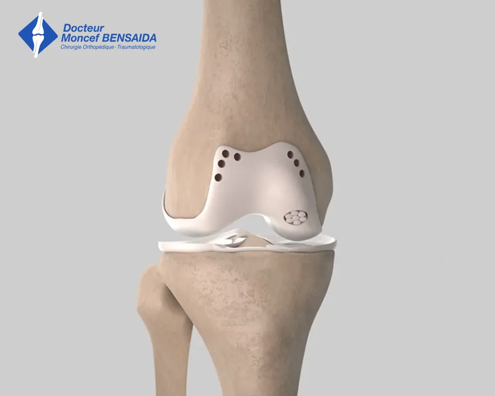 osteochondritis dissecans surgery-image