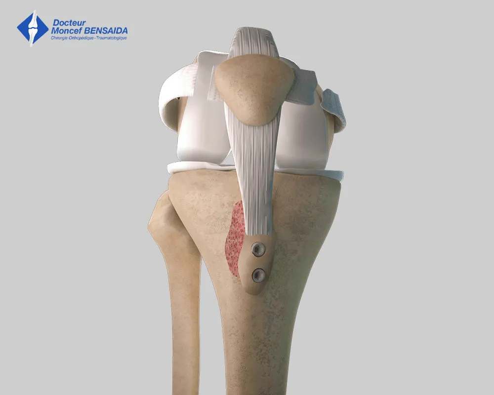 patellar instability surgery-image