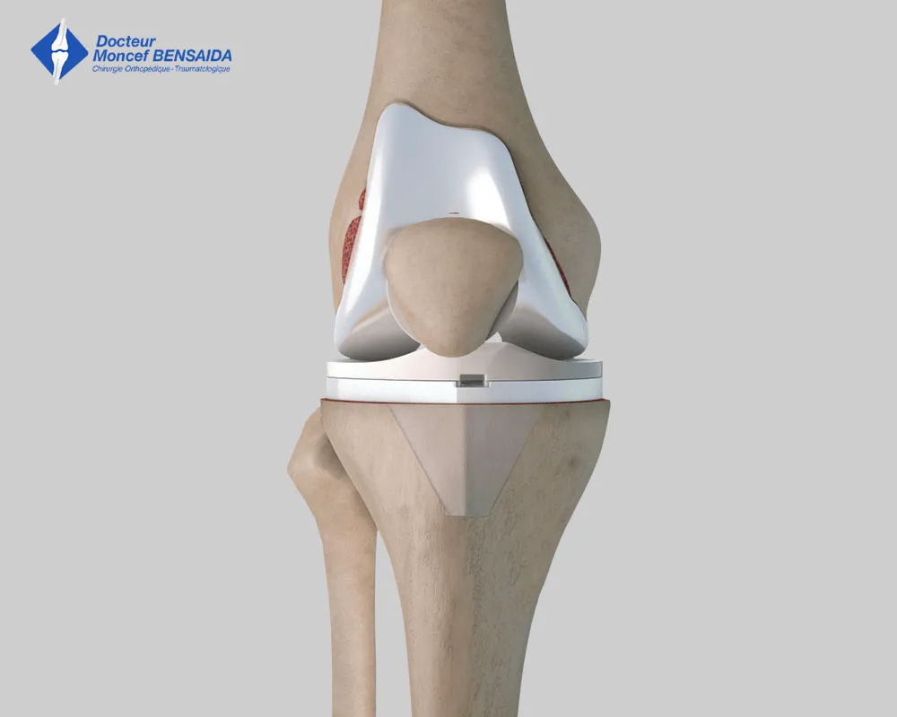 knee replacements-image