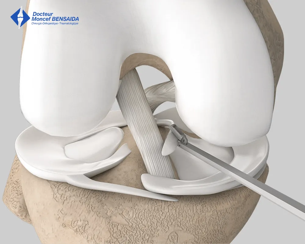 meniscal surgery-image