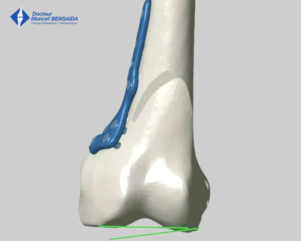 surgery to slow knee osteoarthritis-image
