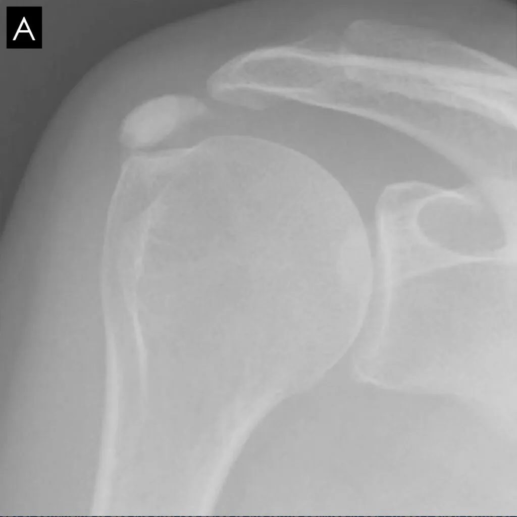 calcification type a