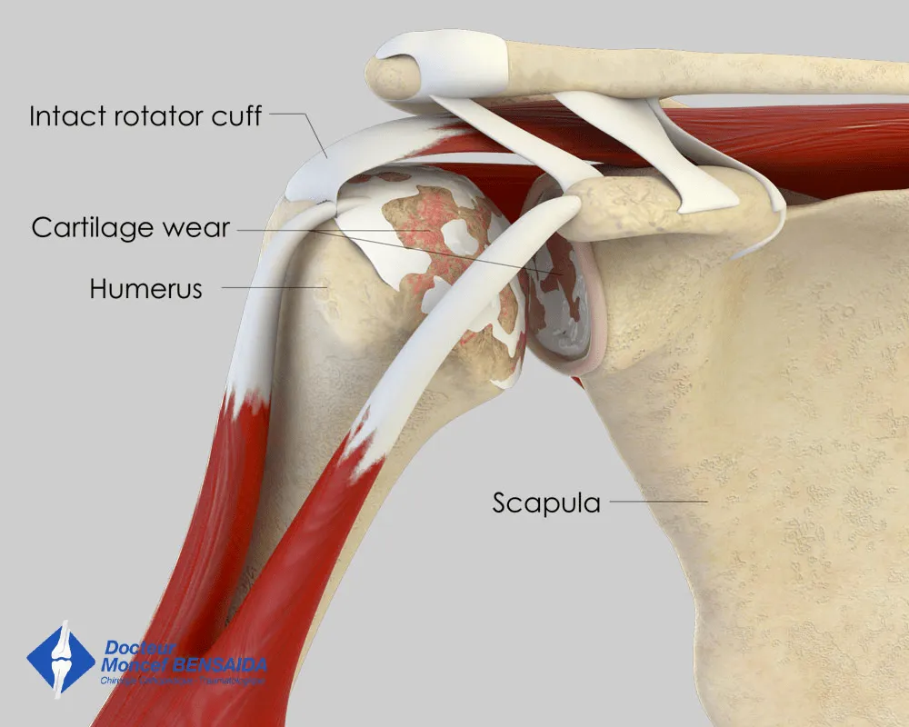Centred glenohumeral osteoarthritis (intact rotator cuff)