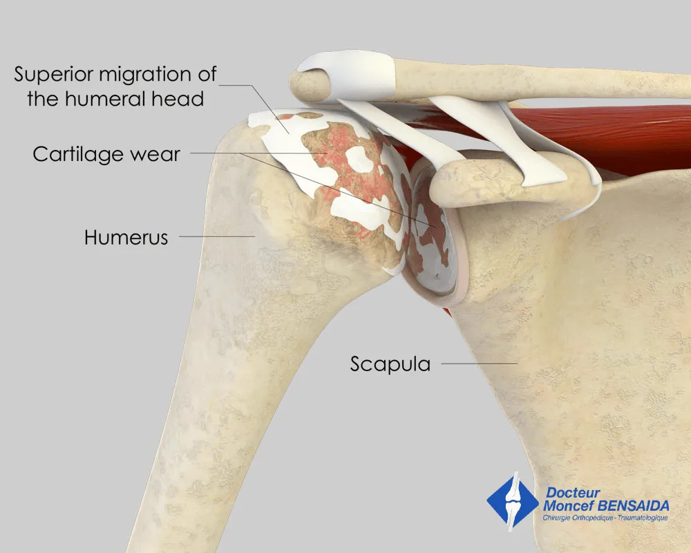 Decentred glenohumeral osteoarthritis (torn rotator cuff)