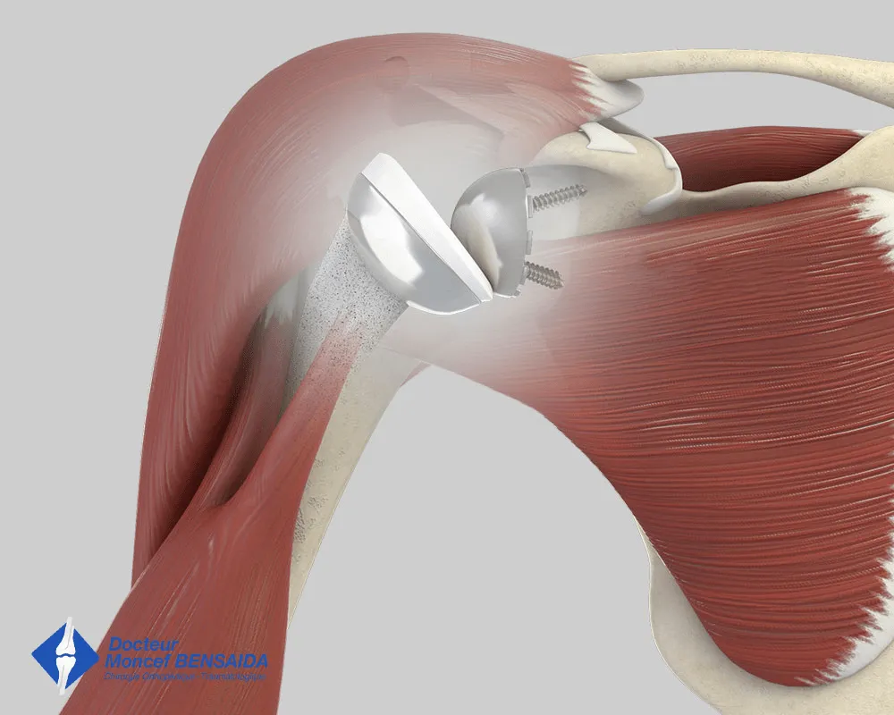 Reverse shoulder replacement