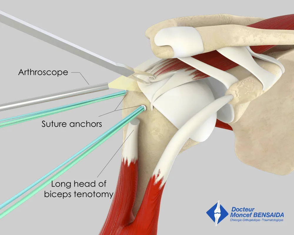 Rotator cuff repair