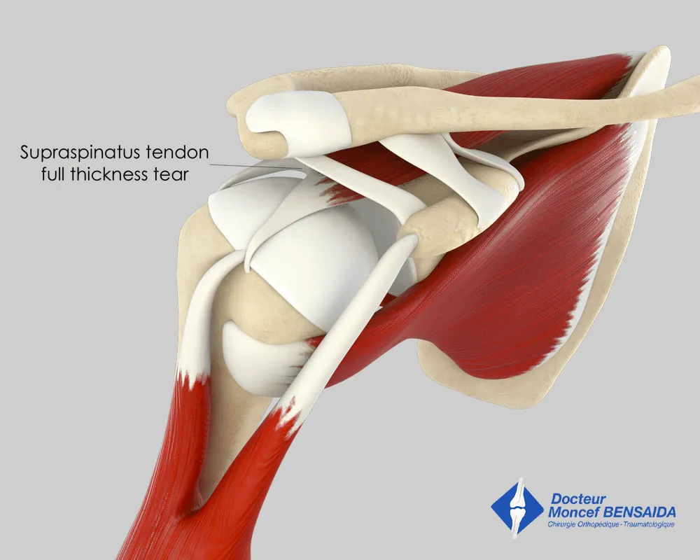 Rotator cuff tendon tear