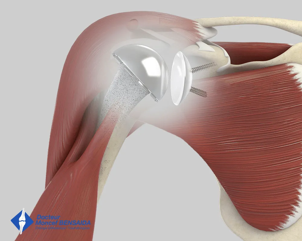 Standard shoulder replacement
