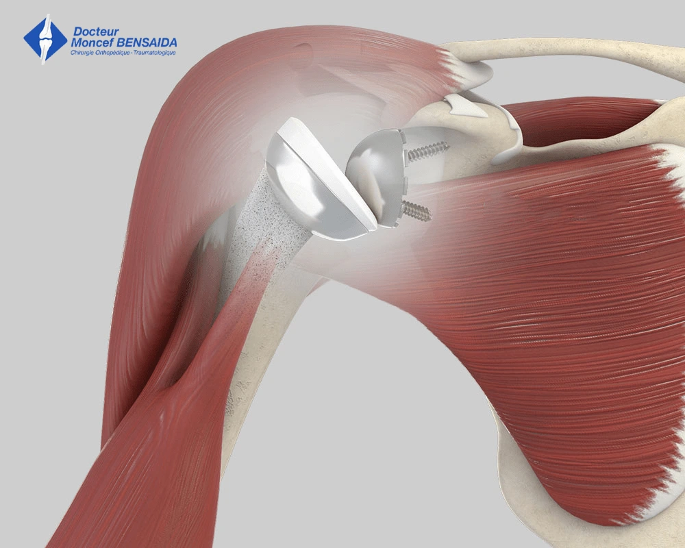 surgical treatment of a painful shoulder-image