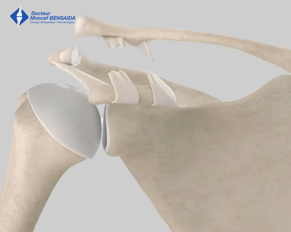 surgical treatment of traumatic shoulder injuries-image