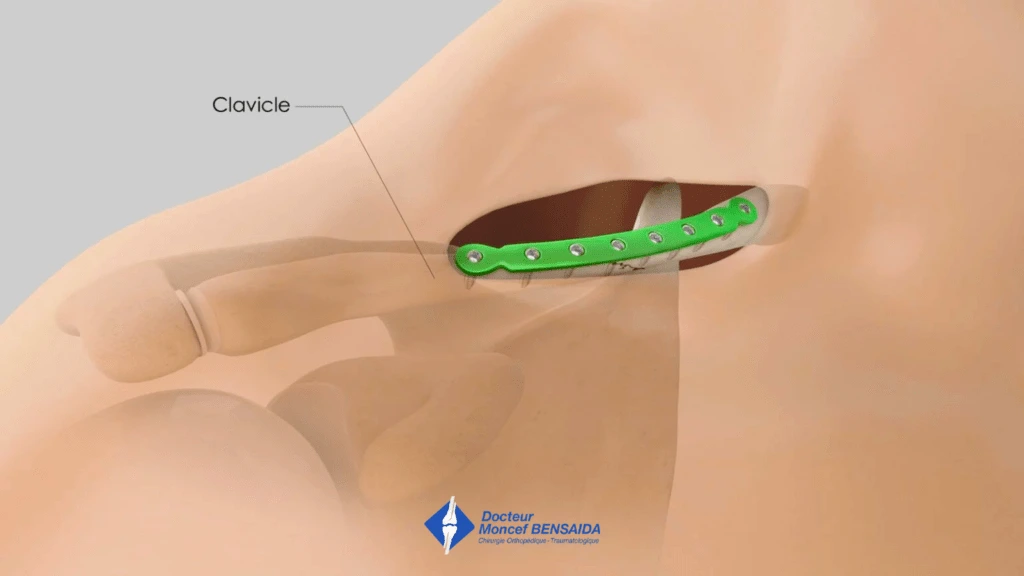 Clavicle osteosynthesis plate fixed with screws