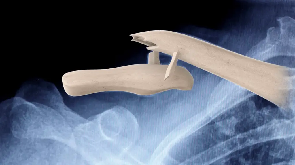 Displaced fracture of the clavicle