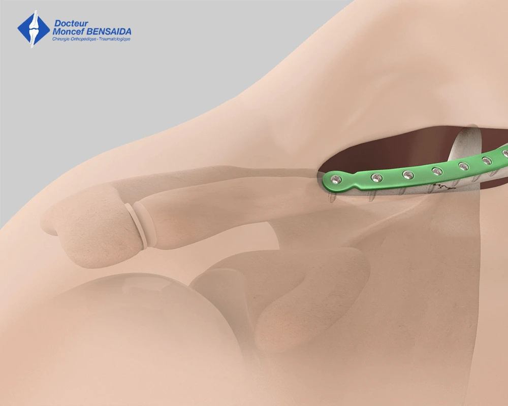 surgical treatment of traumatic shoulder injuries-image