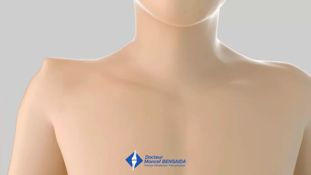 Type 3 and 5 shoulder deformity