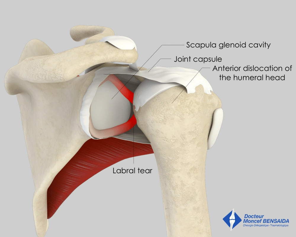 Anterior shoulder dislocation