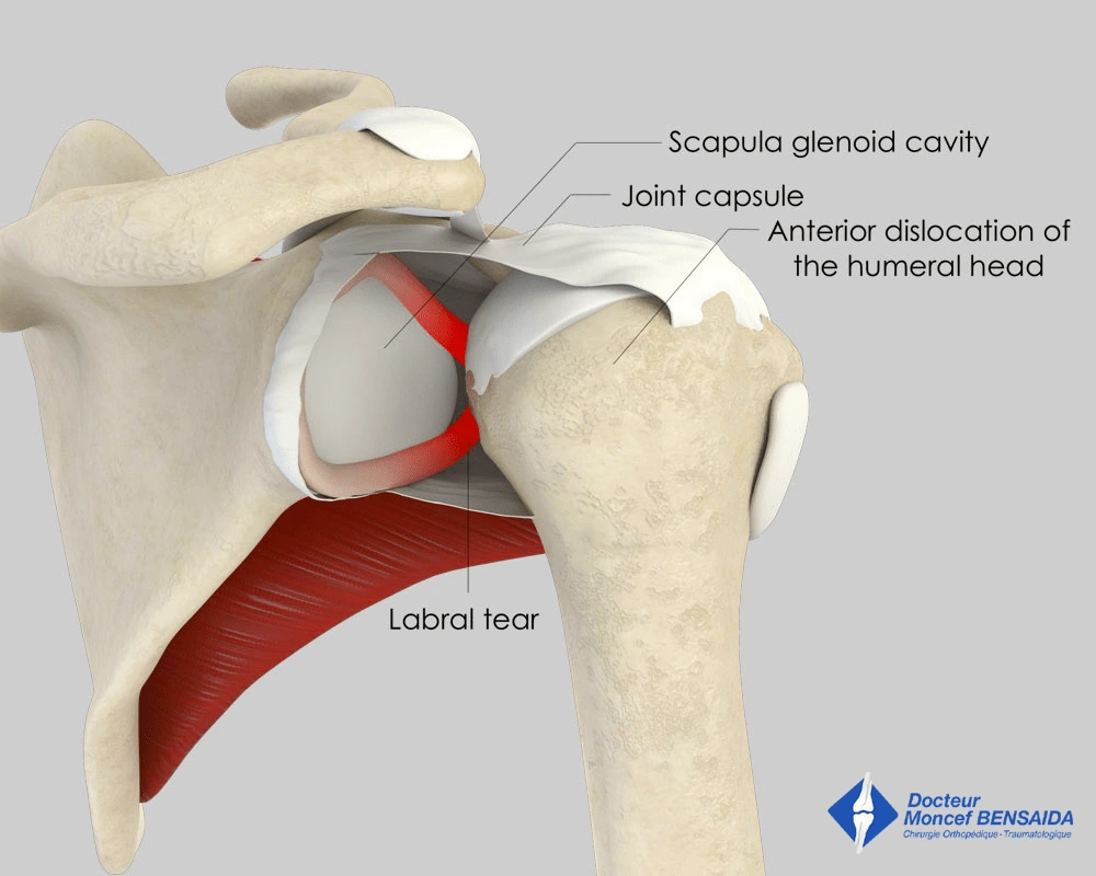 Anterior shoulder dislocation
