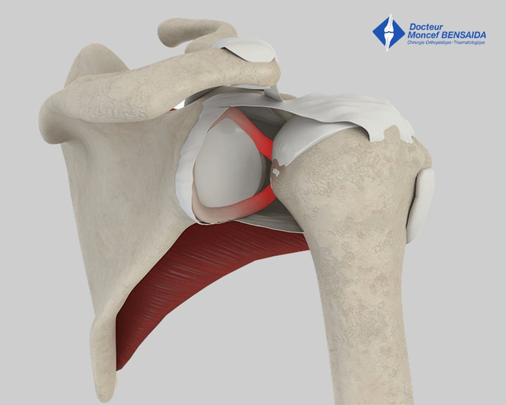 surgical treatment of shoulder instability-image