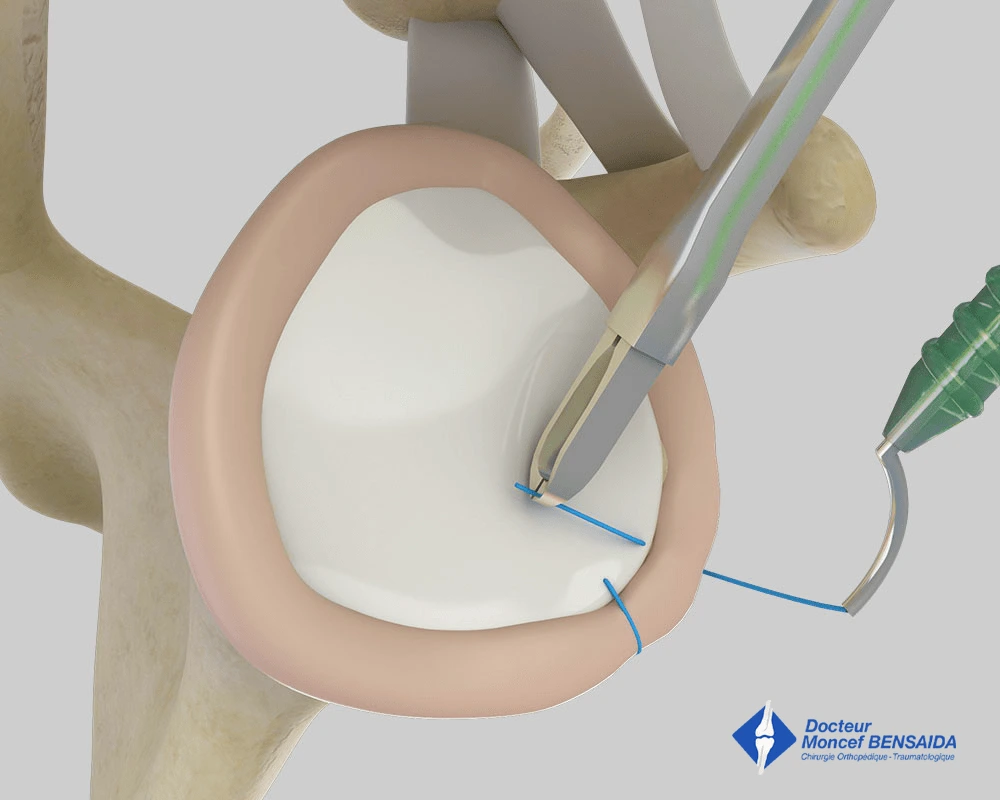 Arthroscopic reinsertion of the labrum (side view)