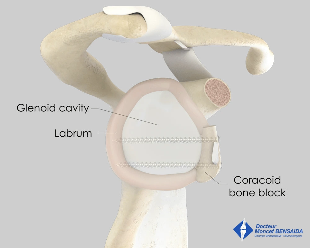 Coracoid bone block (side view): increase in the surface area of the glenoid
