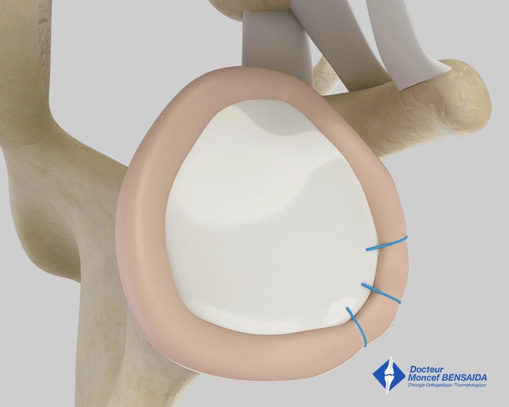 Final appearance of the reinsertion of the labrum (lateral view)