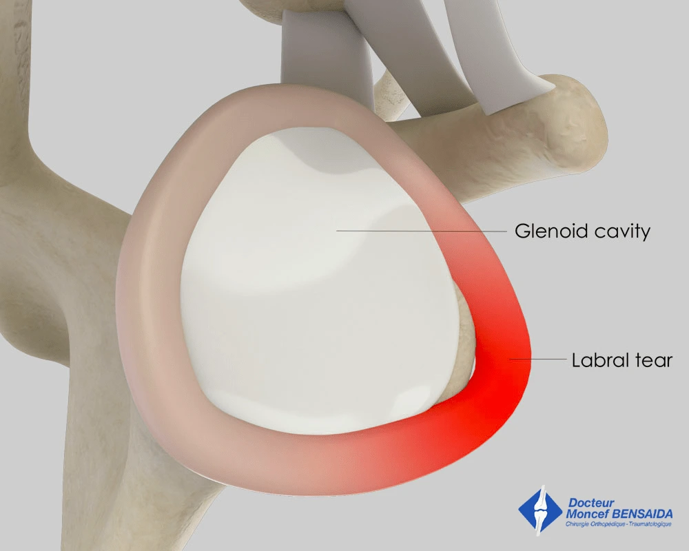 Labrum avulsion (side view)